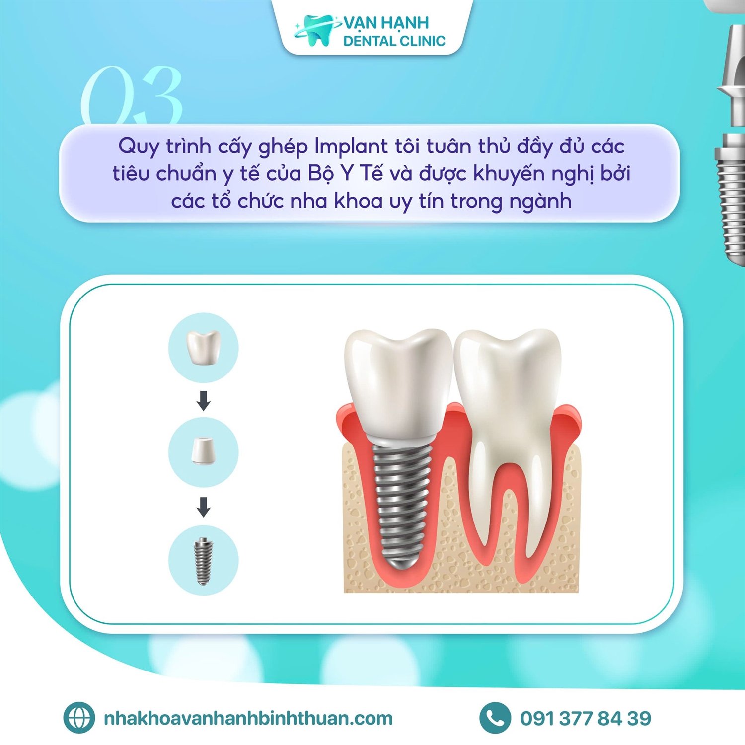 TRỒNG RĂNG IMPLANT - BƯỚC ĐỘT PHÁ CHO NỤ CƯỜI TƯƠI TẮN!