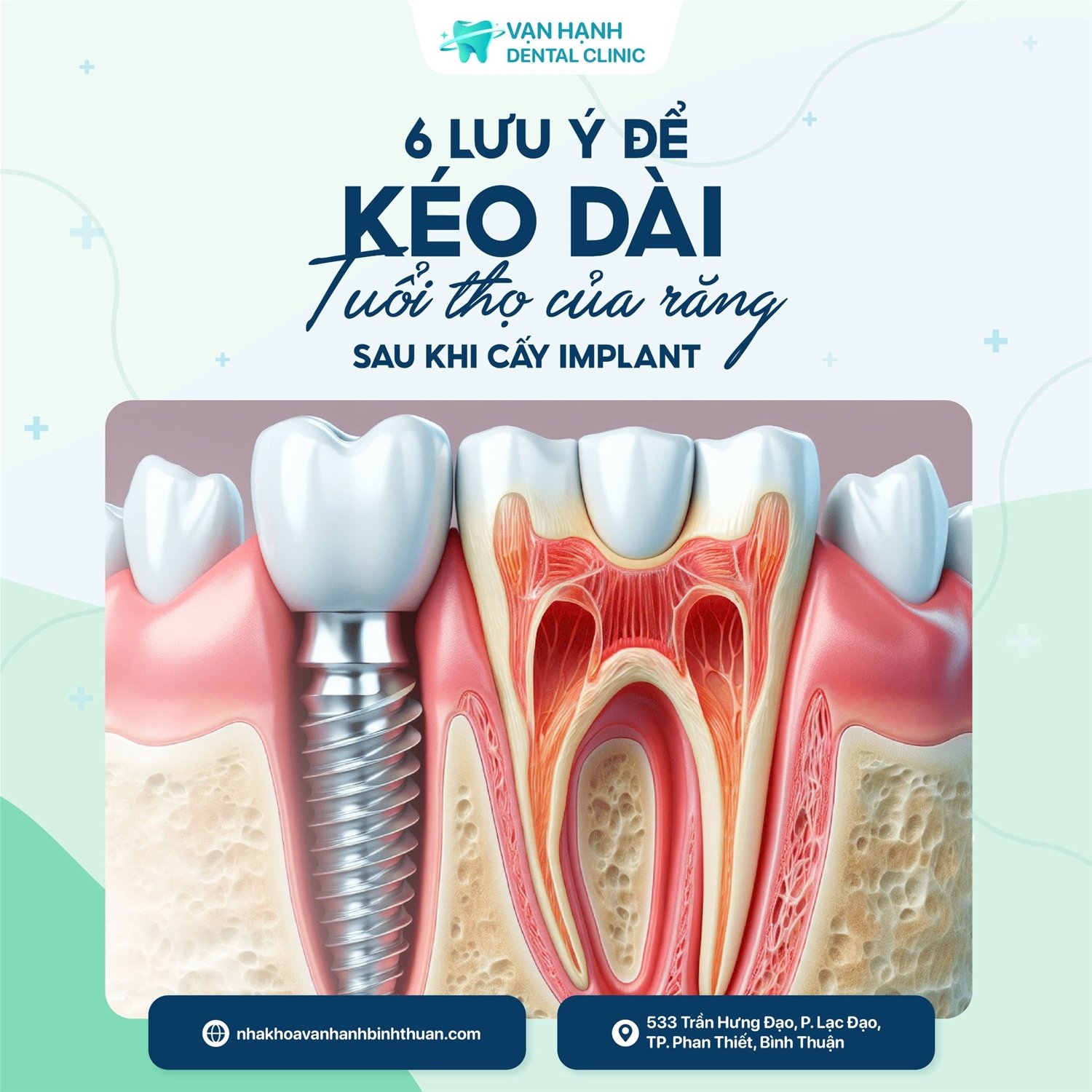 6 LƯU Ý ĐỂ KÉO DÀI TUỔI THỌ CỦA RĂNG SAU KHI CẤY IMPLANT