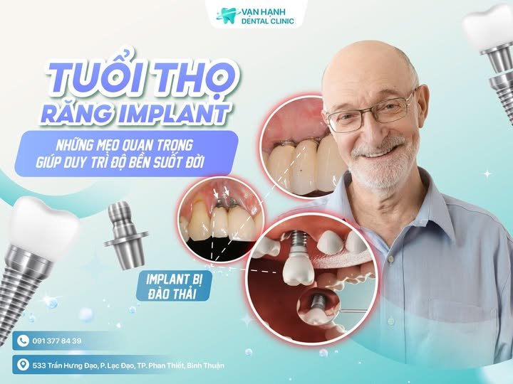 TUỔI THỌ RĂNG IMPLANT: NHỮNG MẸO QUAN TRỌNG GIÚP DUY TRÌ ĐỘ BỀN SUỐT ĐỜI!