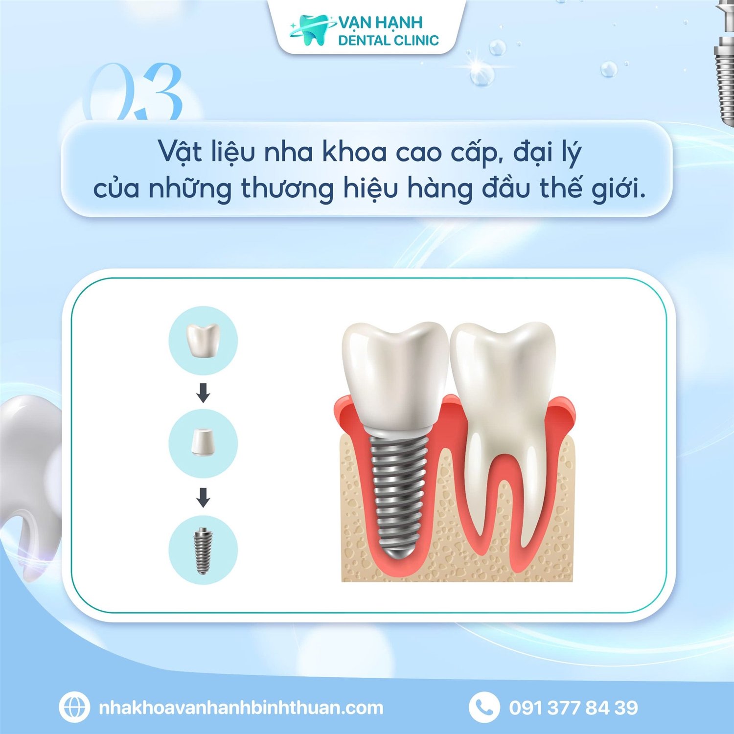 CẤY RĂNG IMPLANT CHỈ SAU 30 PHÚT - TRẢI NGHIỆM CẤY IMPLANT TẠI NHA KHOA VẠN HẠNH BÌNH THUẬN