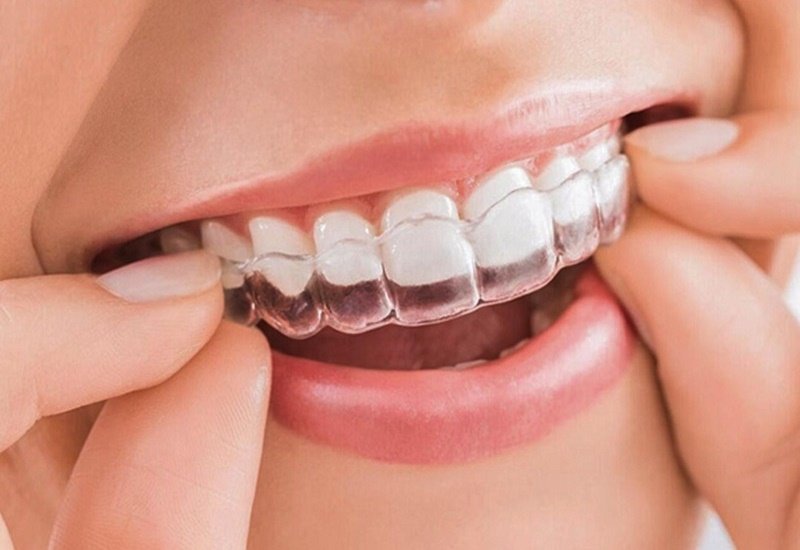 ☄️ INVISALIGN-NIỀNG RĂNG VÔ HÌNH -TỰ TIN GIAO TIẾP