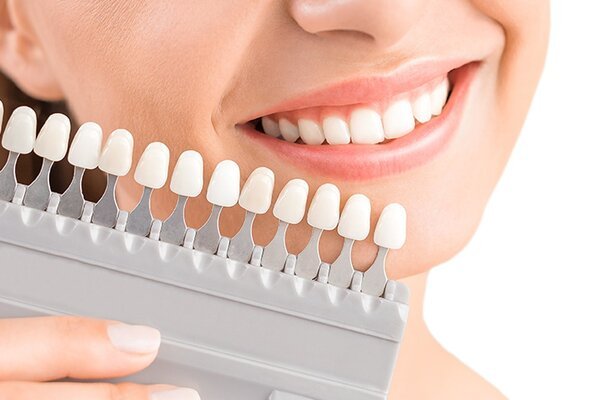 MẶT DÁN SỨ VENEER - CHE KHUYẾT ĐIỂM HOÀN HẢO