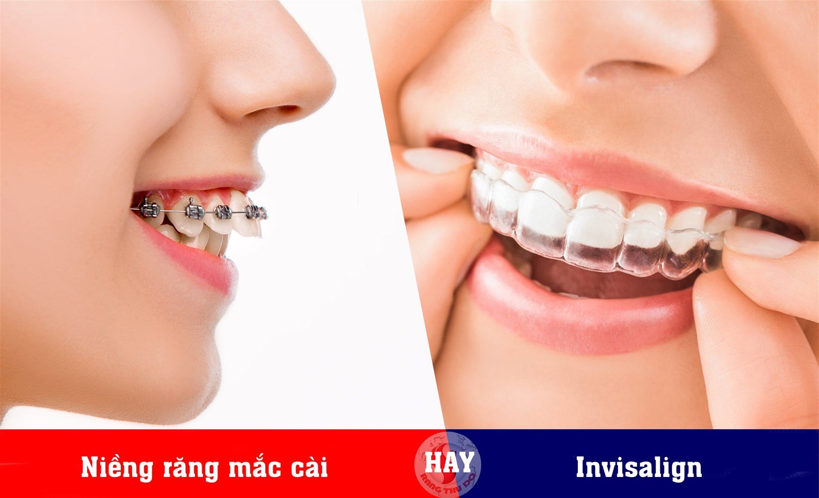 Niềng răng trong suốt mất bao lâu? Có hiệu quả không 2024