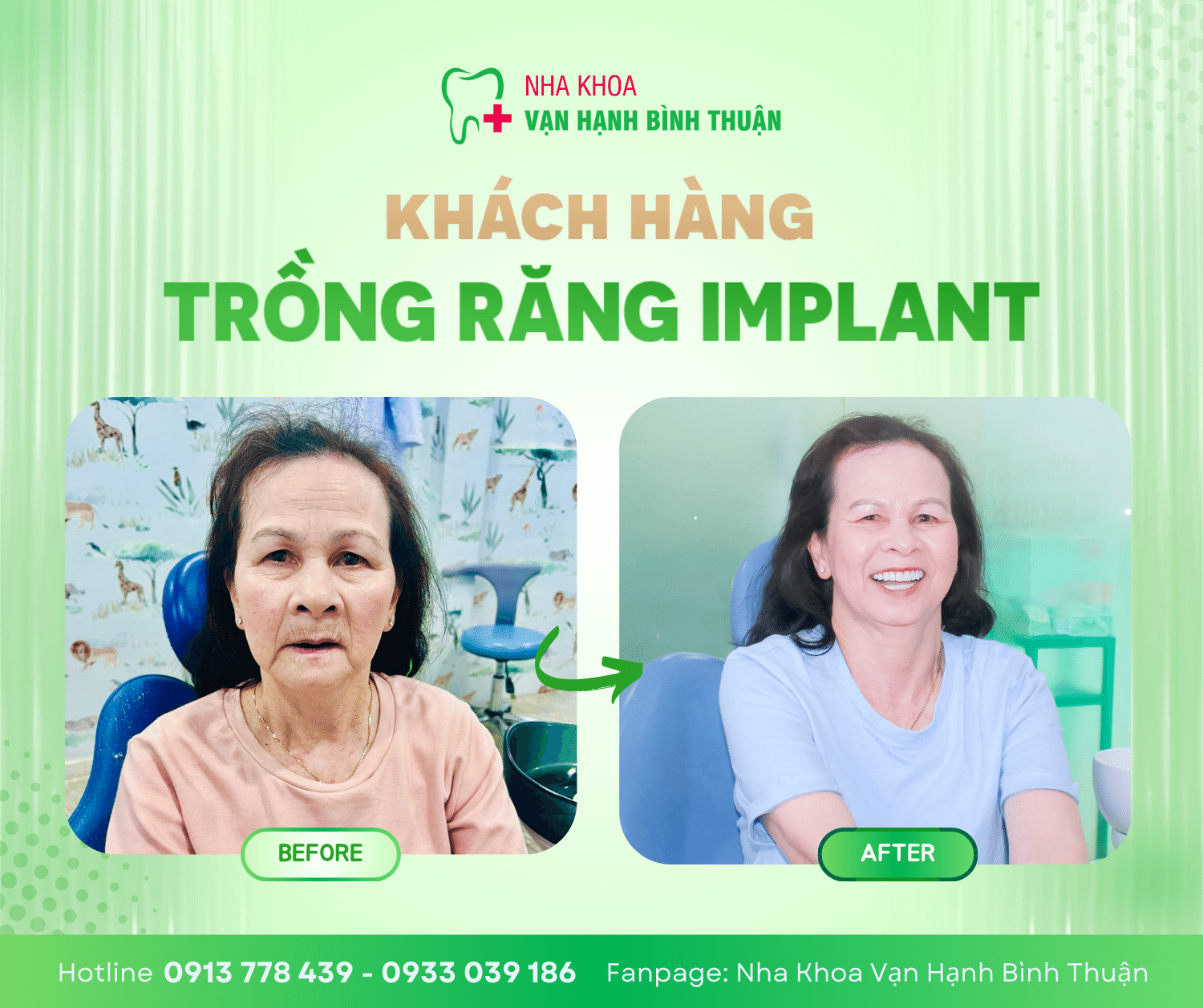 CA LÂM SÀNG ALL-ON X IMPLANT