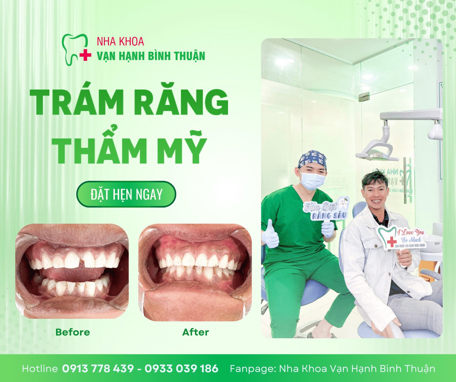 Dịch vụ Trám răng thẩm mỹ tại nha khoa Vạn Hạnh Bình Thuận