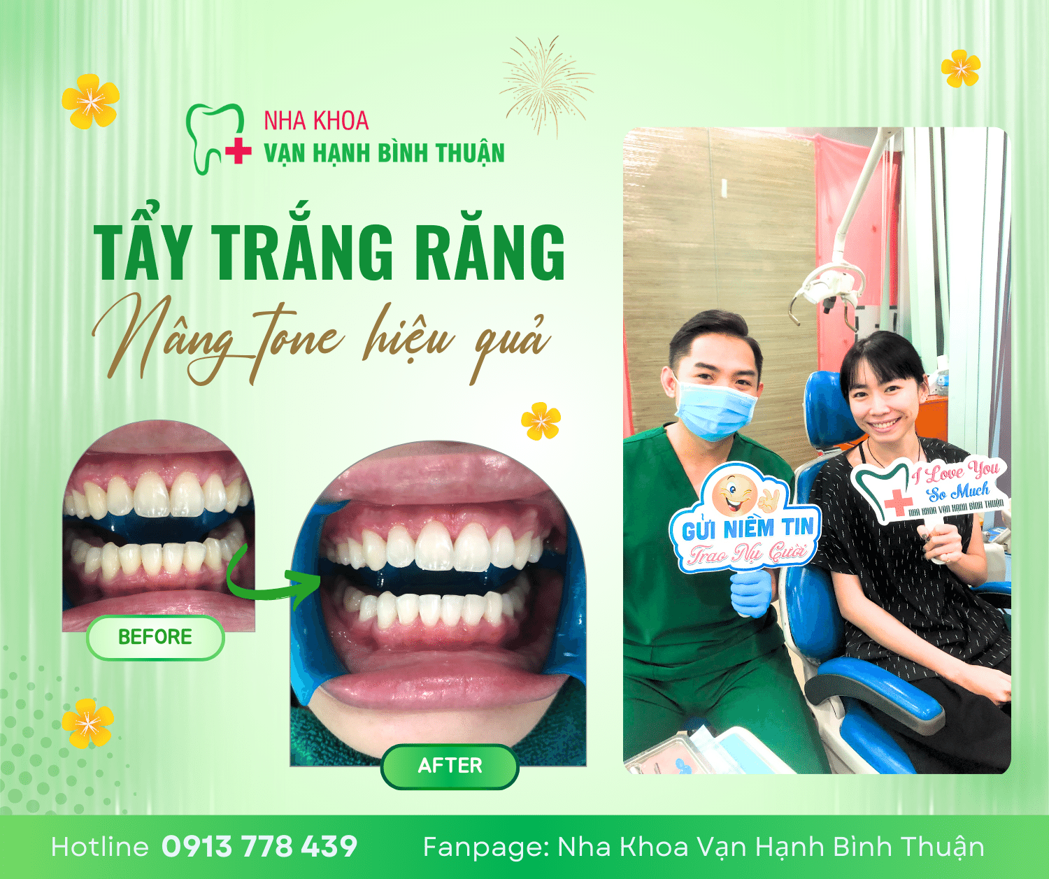 Dịch vụ Tẩy trắng răng tại Nha khoa Vạn Hạnh Bình Thuận