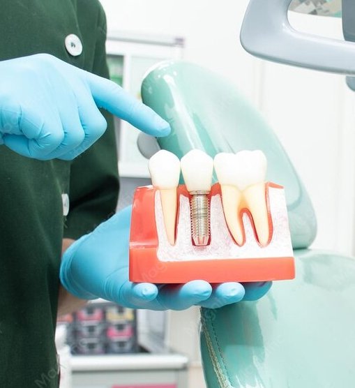 Implant