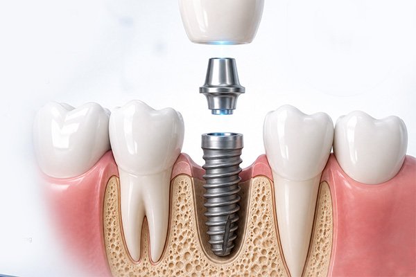 Implant_don