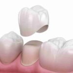 Bọc răng sứ trực tiếp
