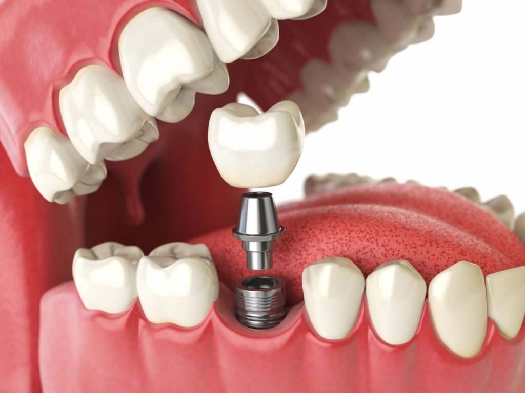 Bọc răng sứ dưới chân Implant