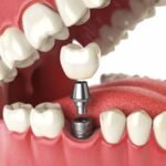 Bọc răng sứ dưới chân Implant
