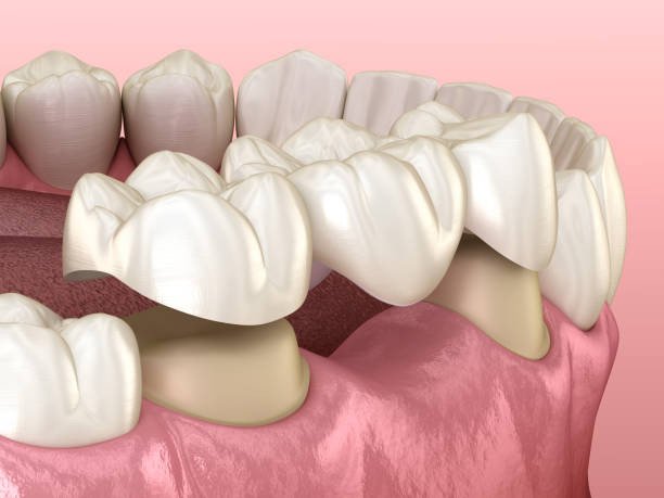 Bọc răng sứ gián tiếp