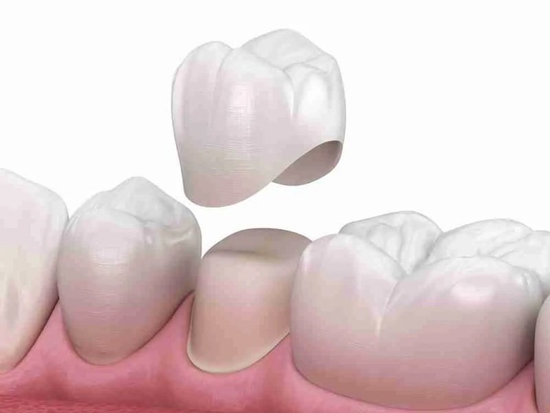 Bọc răng sứ trực tiếp
