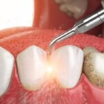 cạo vôi răng bằng dụng cụ cầm tay