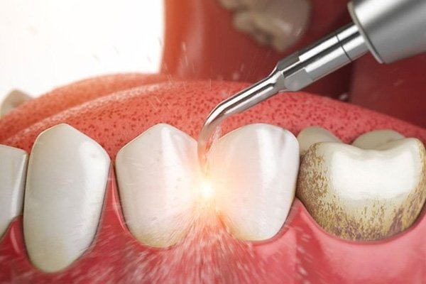 cạo vôi răng bằng dụng cụ cầm tay