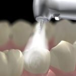 cạo vôi răng bằng sóng siêu âm