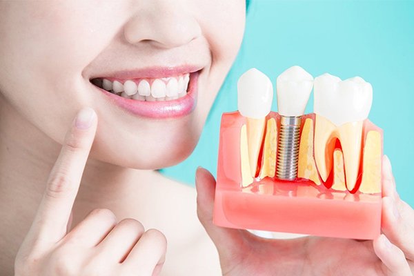 Cấy ghép Implant