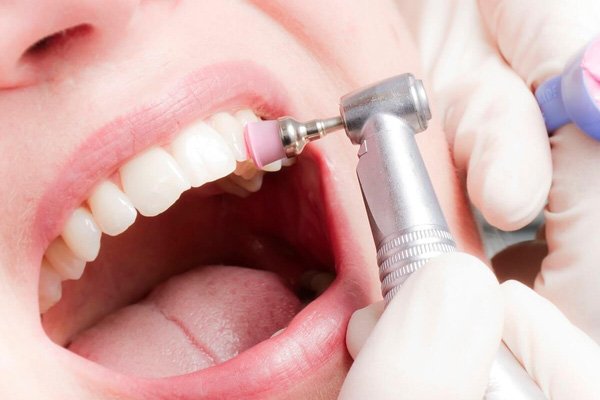 Đánh bóng răng sau khi cạo