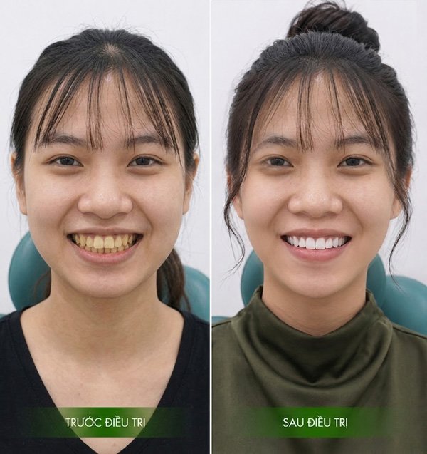 Hình ảnh thực tế sau khi tẩy trắng răng