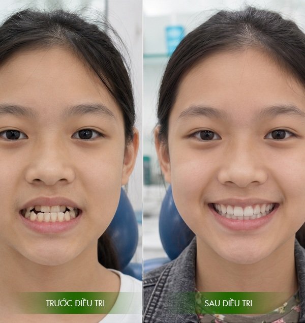 Kết quả sau khi niềng răng tại nhà khoa vạn hạnh bình thuận