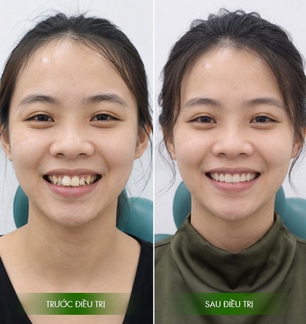 Kết quả sau khi niềng răng tại nhà khoa vạn hạnh bình thuận