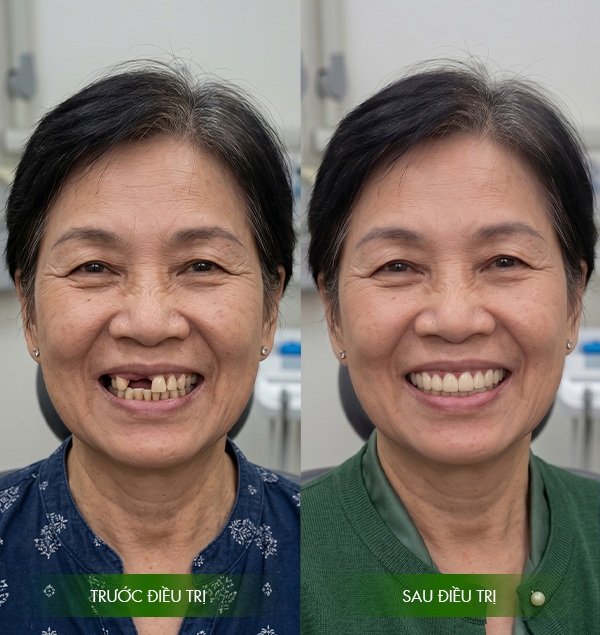 Kết quả khi trồng Implant tại Vạn Hạnh Bình Thuận