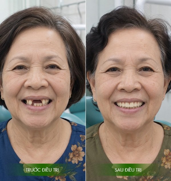 Kết quả khi trồng Implant tại Vạn Hạnh Bình Thuận