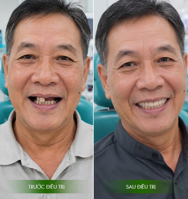 Kết quả khi trồng Implant tại Vạn Hạnh Bình Thuận