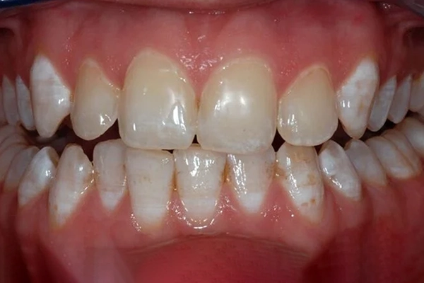 Màu răng không đều làm mất thẩm mỹ