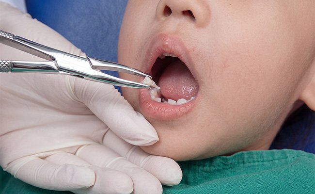 Nhổ răng sữa đúng thời điểm