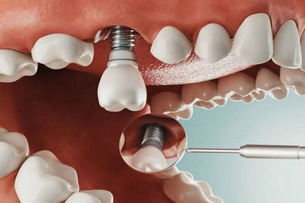 Phục hình cố định