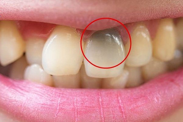 Phương pháp tẩy trắng răng chết tủy