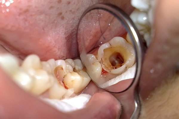 Răng hư hỏng nặng khó phục hồi