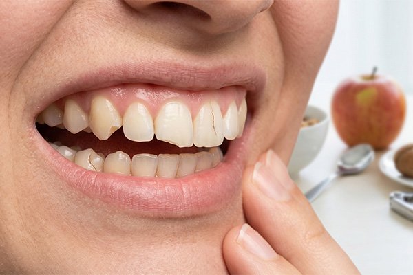 Răng mẻ vở do ăn nhai