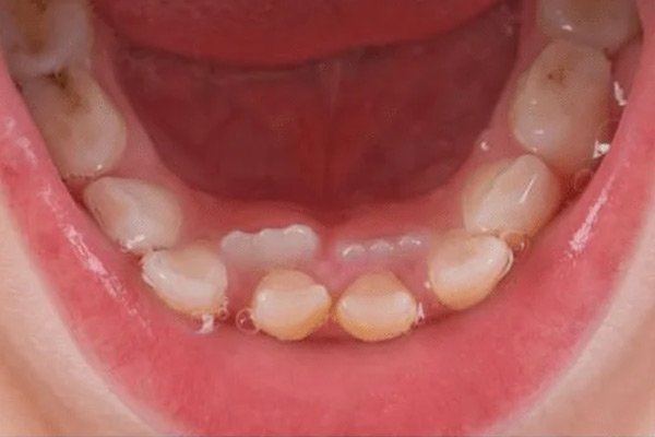 Răng sửa mọc lệch hoặc mất sớm