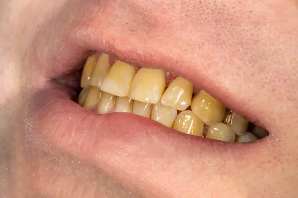 tình trạng răng bị xỉn màu