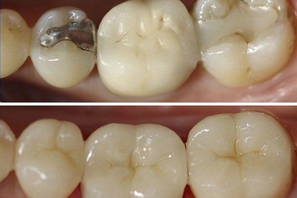 Trám lại miếng trám cũ