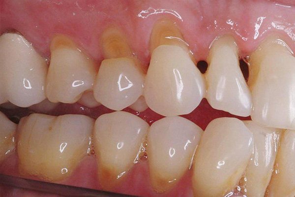 Trám mòn cổ răng