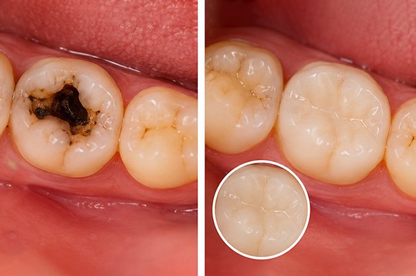 Trám răng sâu điều trị