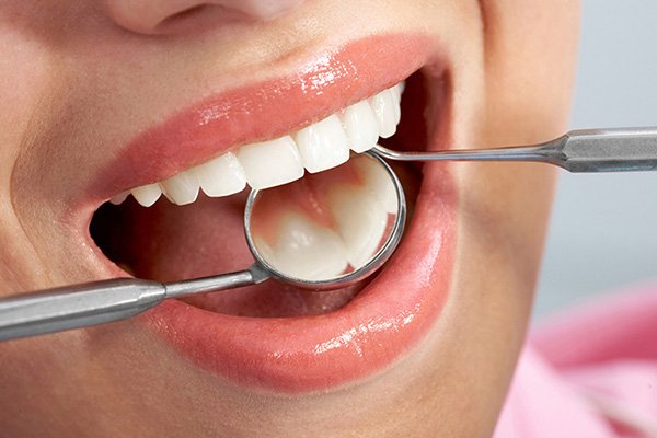 Trám thẩm mỹ