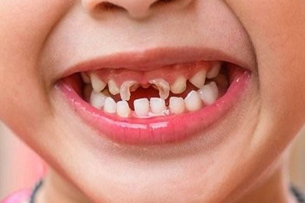Trẻ bị sâu răng do ăn nhiều bánh kẹo